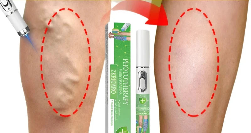 High tech Laser therapy improves moderate varicose veins relieves pain and Improves circulation for men women - Supersell 